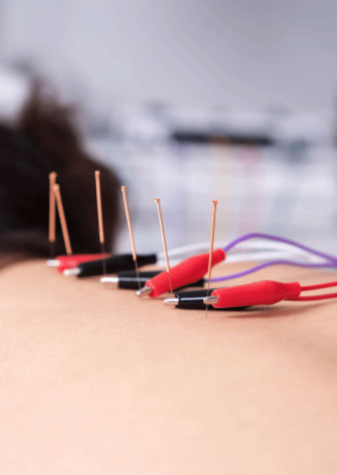xxii-curso-electroneuroacupuntura